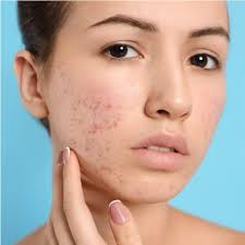 Restoring Beauty: Effective Acne Scar Treatment in Islamabad"