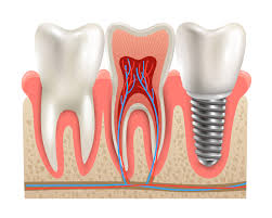 A Comprehensive Overview of Root Canal Treatment in Islamabad: Restoring Dental Wellness